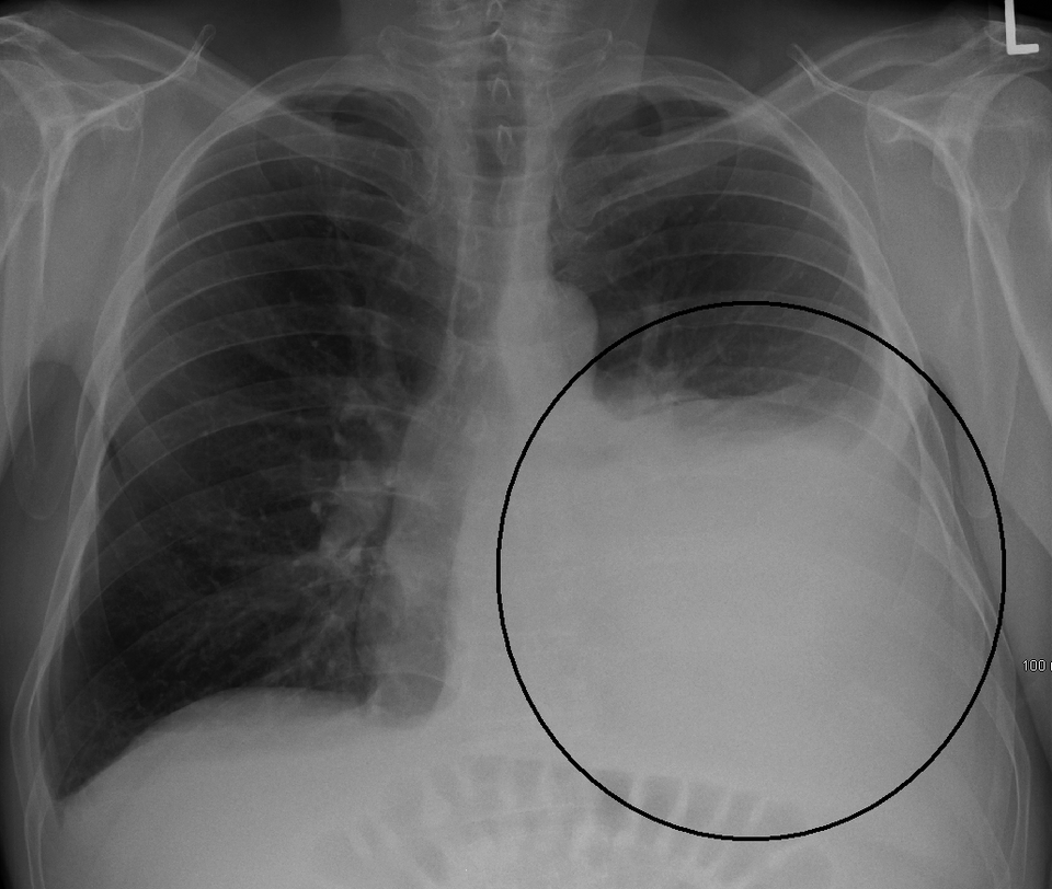 Radiografía de tórax: gran derrame pleural izquierdo con menisco