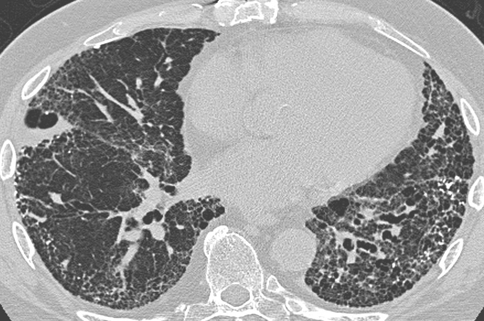 TC de alta resolución: patrón UIP con panalización subpleural