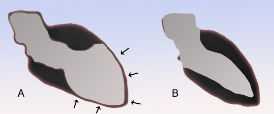 Esquema del ventrículo izquierdo en sístole: Takotsubo con balonamiento apical vs. normal