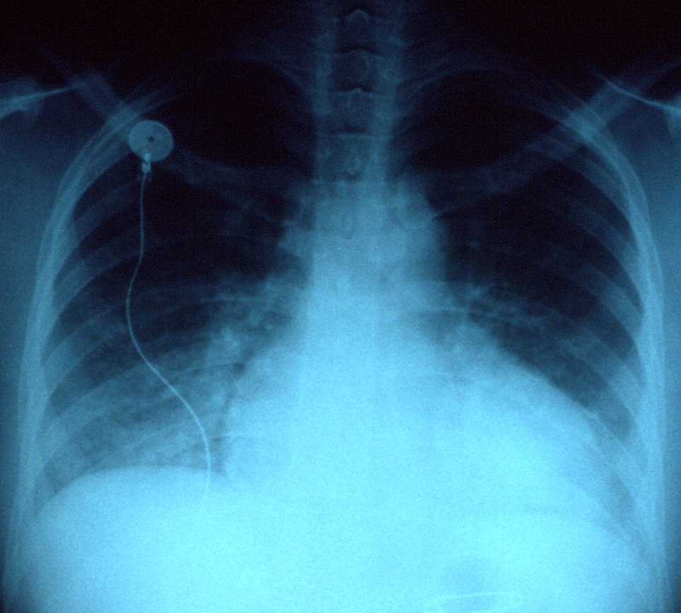 Radiografía: cardiomegalia con silueta globular y congestión, en insuficiencia cardíaca