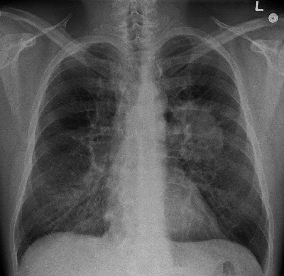 Radiografía: masa pulmonar redondeada (cáncer de pulmón)