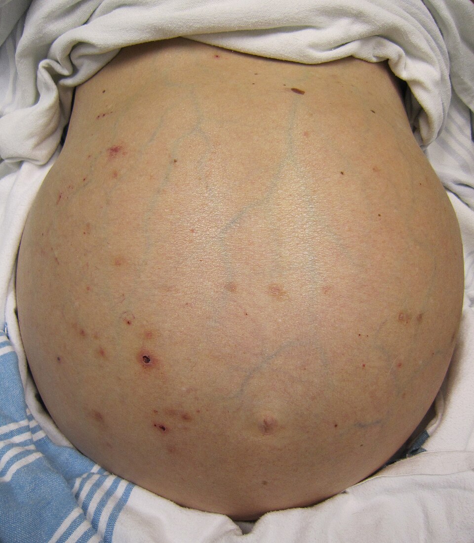 Abdomen distendido por ascitis a tensión con arañas vasculares