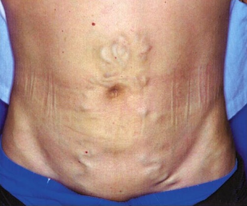 Cabeza de medusa: venas periumbilicales dilatadas en un paciente con hipertensión portal