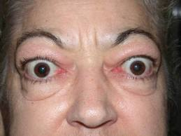 Facies hipertiroidea