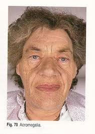 Facies acromegálica