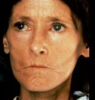 Facies esclerodérmica